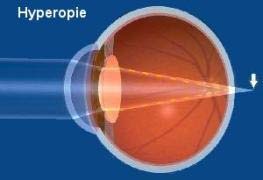 Erklärende Darstellung der Weitsichtigkeit (Hyperopie)