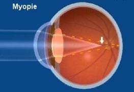 Erklärende Darstellung der Kurzsichtigkeit (Myopie)